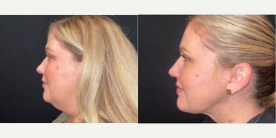 Liposuction before and after photo