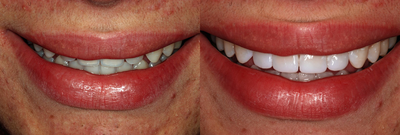 Dental Bonding before and after photo