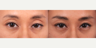 Double Eyelid Surgery before and after photo