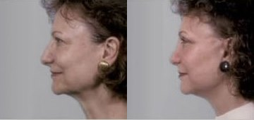 Facelift before and after photo