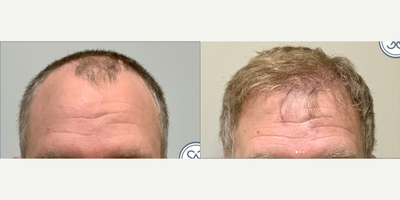 Hair Transplant before and after photo