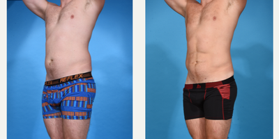 Abdominal Etching before and after photo
