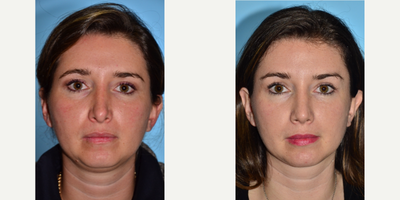 Brow Lift before and after photo
