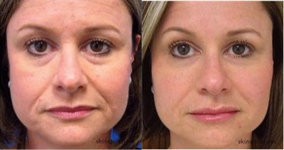 Dermal Fillers before and after photo