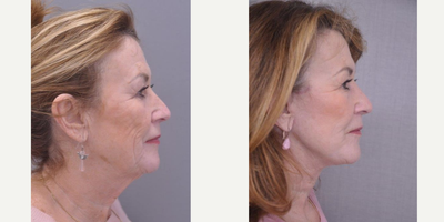 Facelift before and after photo