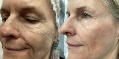 Laser Resurfacing before and after photo