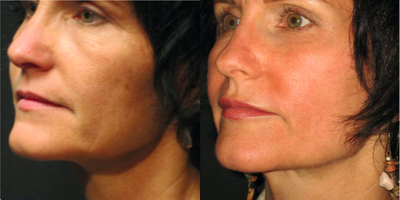 Lip Fillers before and after photo