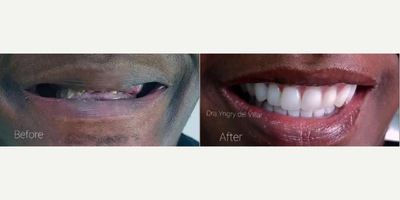 Porcelain Veneers before and after photo