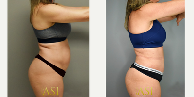 Skin Tightening before and after photo