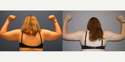 Arm Lift before and after photo