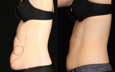 CoolSculpting before and after photo
