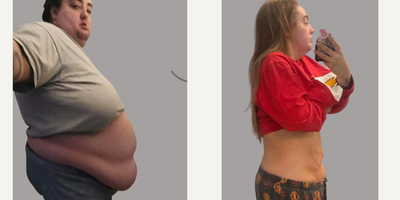 Gastric Sleeve Surgery before and after photo
