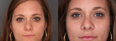 Lip Fillers before and after photo