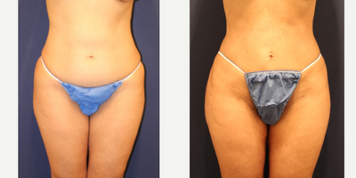 Liposuction before and after photo