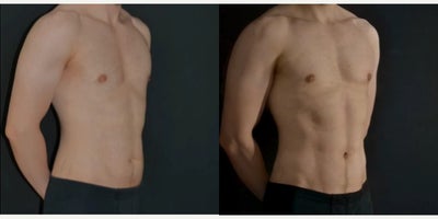 Liposuction before and after photo