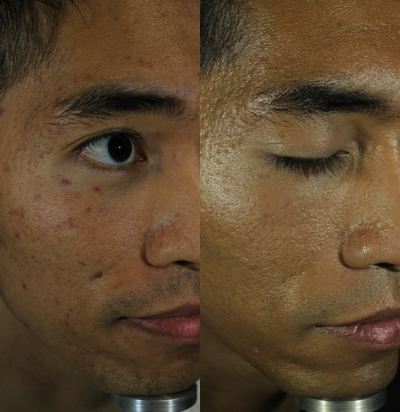 Microneedling before and after photo