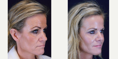 Rhinoplasty before and after photo