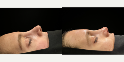 Septoplasty before and after photo