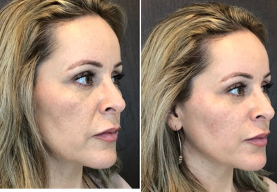 Voluma before and after photo