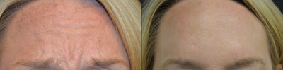 Botox before and after photo