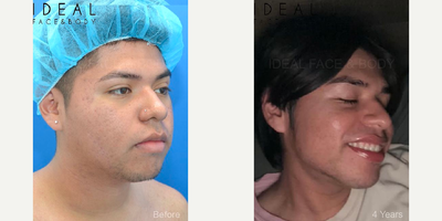 Botox before and after photo