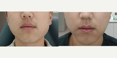 Botox before and after photo