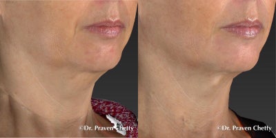 Kybella before and after photo