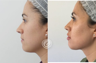 Lip Fillers before and after photo