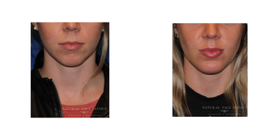 Lip Fillers before and after photo