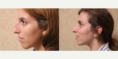 Rhinoplasty before and after photo