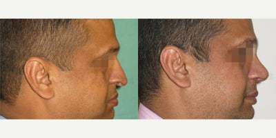 Rhinoplasty before and after photo