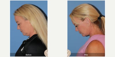 Rhinoplasty before and after photo