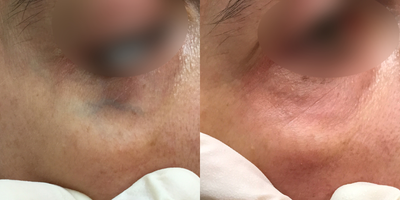 YAG Laser before and after photo