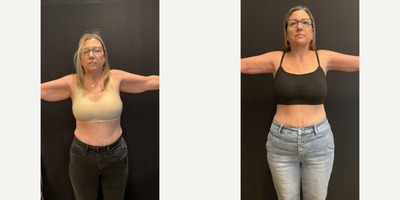 Arm Lift before and after photo