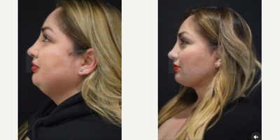 Chin Liposuction before and after photo
