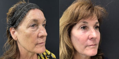 Eyelid Surgery before and after photo