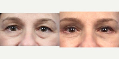 Eyelid Surgery before and after photo