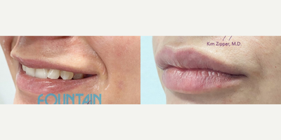 Juvederm before and after photo