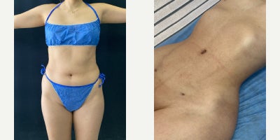 Liposculpture before and after photo