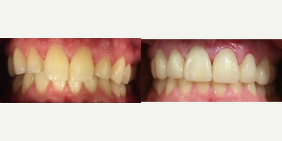 Lumineers before and after photo