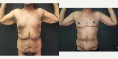 Body Lift before and after photo