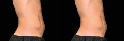 Emsculpt before and after photo