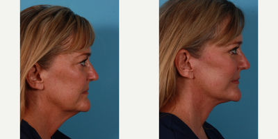 Facelift before and after photo