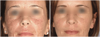 ActiveFX before and after photo