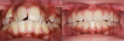 Braces before and after photo