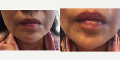 Chin Filler before and after photo