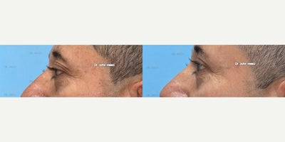 Eyelid Surgery before and after photo