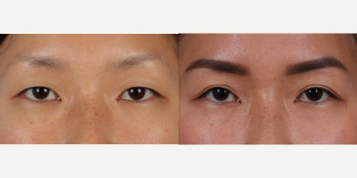 Eyelid Surgery before and after photo