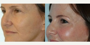 Facial Fat Transfer before and after photo