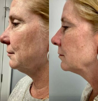 Sofwave before and after photo